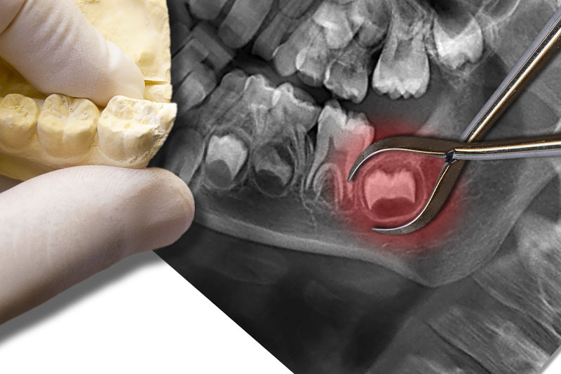 wisdom tooth that is impacted and need to be removed.