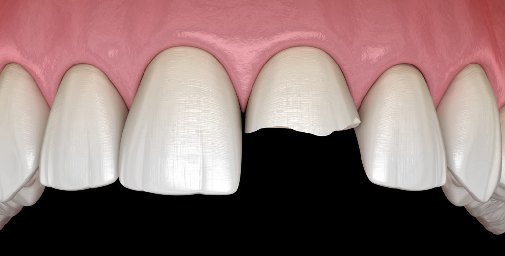 How a General Dentist Uses Crowns to Repair Teeth