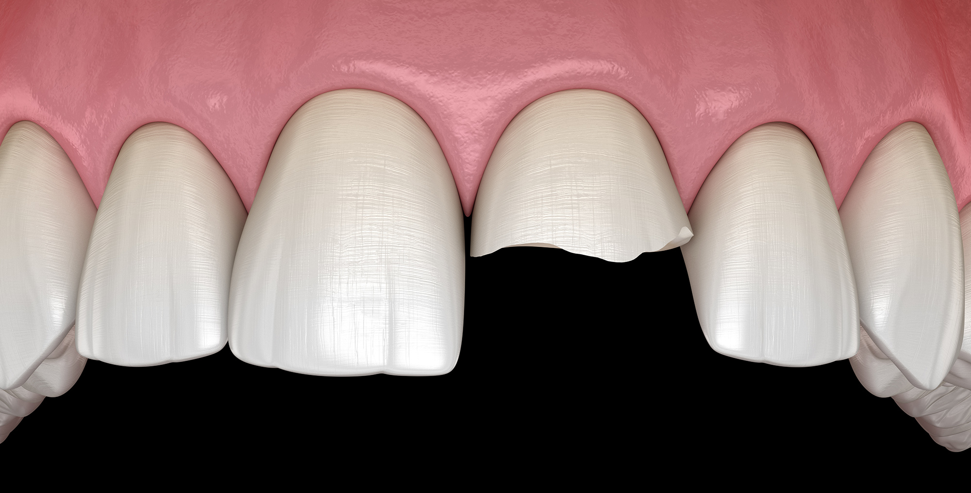 Cracked Tooth Albuquerque, NM Precision Dental Care