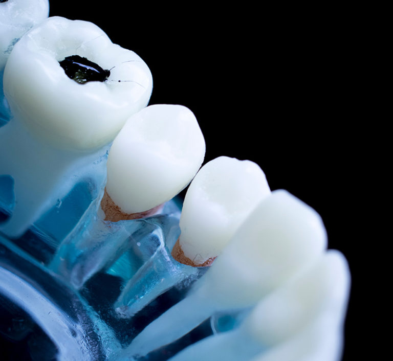 Cavity Fillings Albuquerque, NM Precision Dental Care