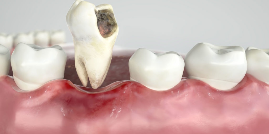 How Long Does It Take For Teeth To Shift After Extraction