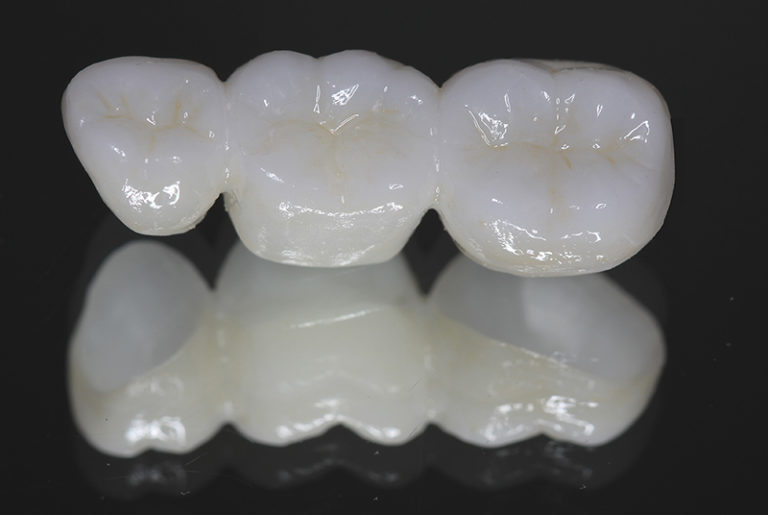 Zirconia Fixed Bridge Albuquerque, NM Precision Dental Care