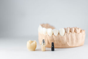 jaw model in grey background with implant laying in front