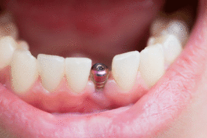 an image of a dental implant in a mouth.
