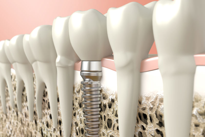 dental implants model.