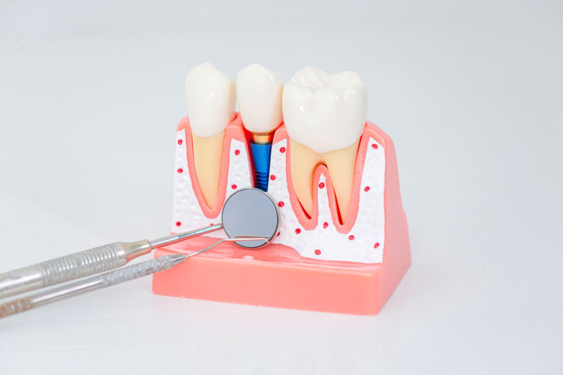 Dental implant, artificial tooth roots into jaw, root canal of dental treatment, gum disease, teeth model for dentist studying about dentistry
