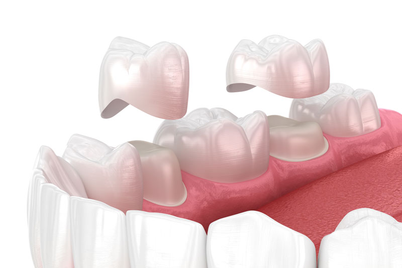 3D rendering of a dental crown being placed on a prepared tooth, showing how crowns restore damaged teeth in Albuquerque NM.